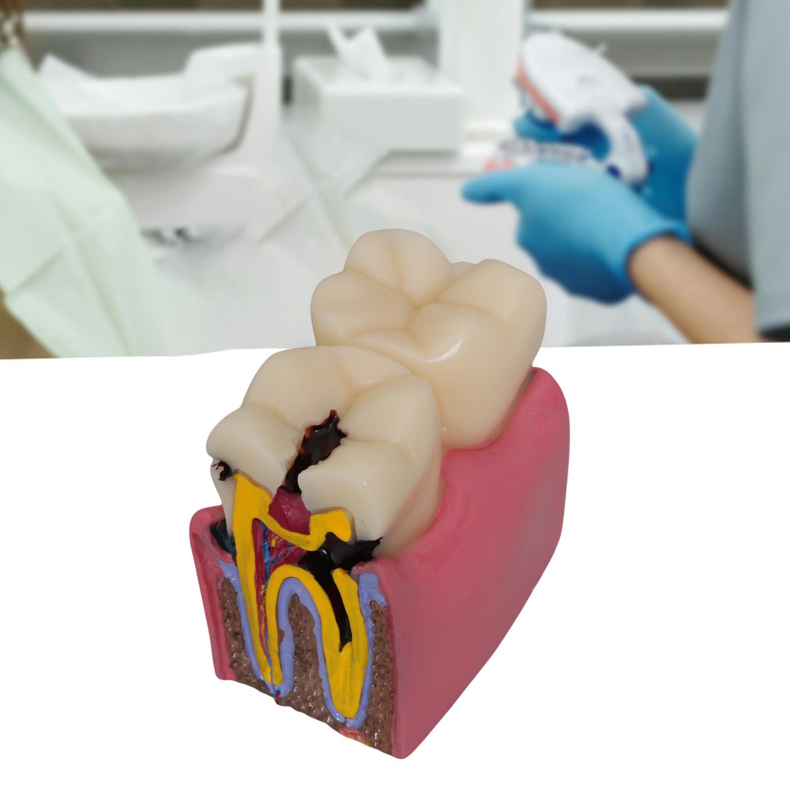 Kids Education Classes - Zahnkaries-Modell, Wurzeln, Kanal, Lehr-Requisite, Bildungsbedarf, 6-faches